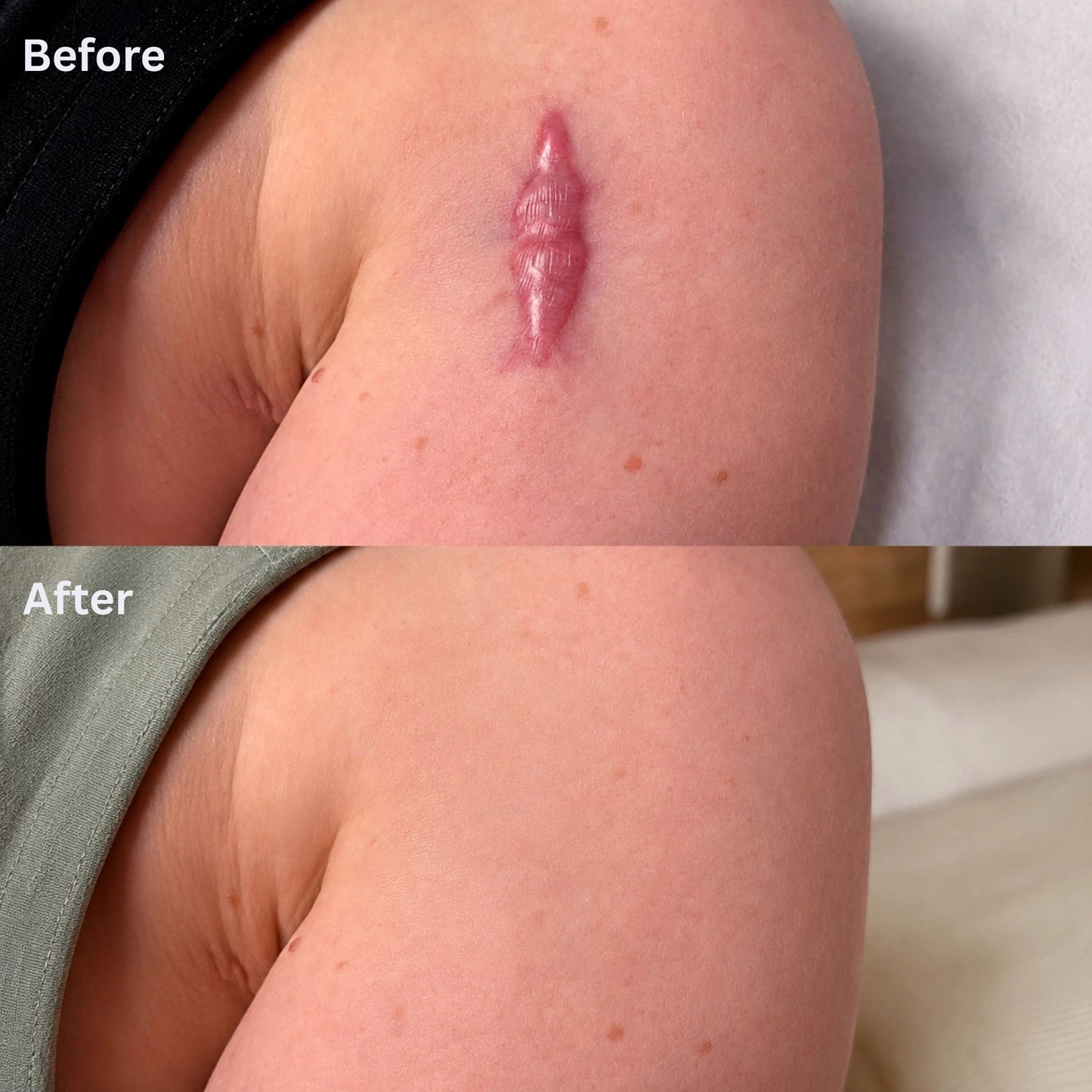 Erase Hardened Scars Completely. Reveal Smooth, Uniform Skin in Days.