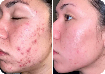 Rosacea Corrector