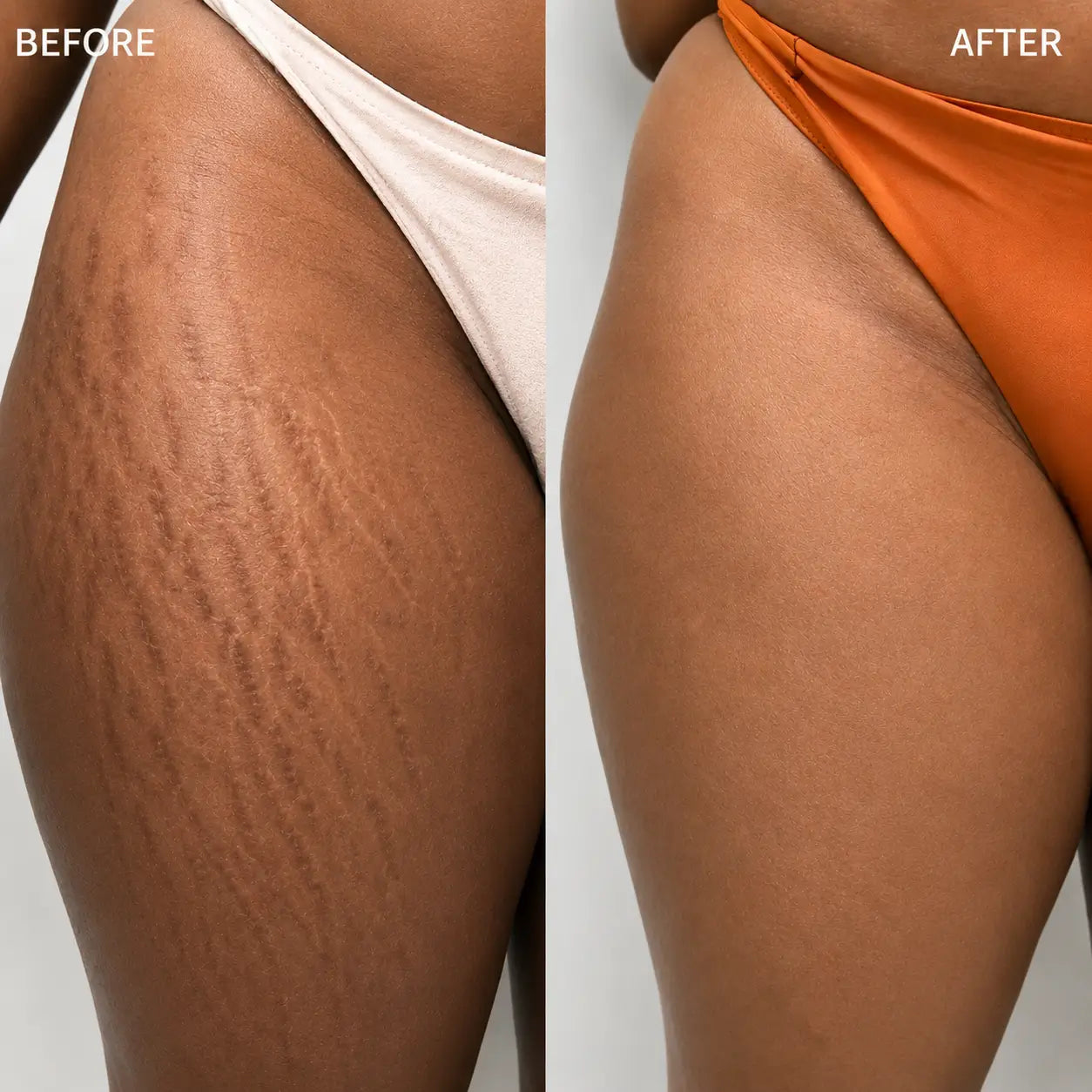 Erase Hardened Scars Completely. Reveal Smooth, Uniform Skin in Days.