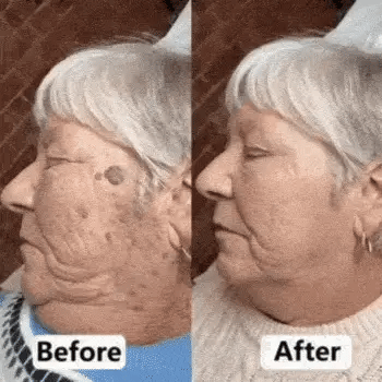 2026 SKIN RESTORATION ROUTINE-7-Day Skin Tag & Blemish Repair Pen