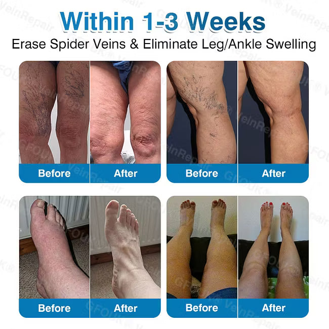 👨‍⚕️✅ VeinRepair Microneedle Patch Roll⚡Instant Relief, Long-Term Results