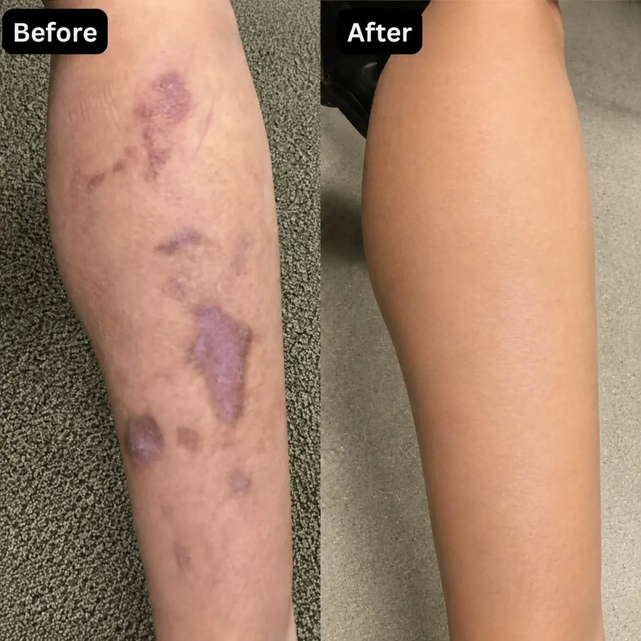 Erase Hardened Scars Completely. Reveal Smooth, Uniform Skin in Days.
