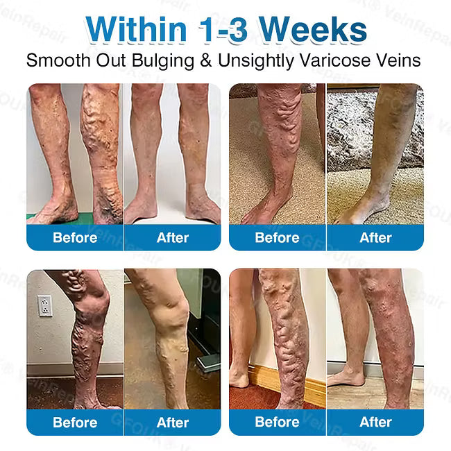 👨‍⚕️✅ VeinRepair Microneedle Patch Roll⚡Instant Relief, Long-Term Results