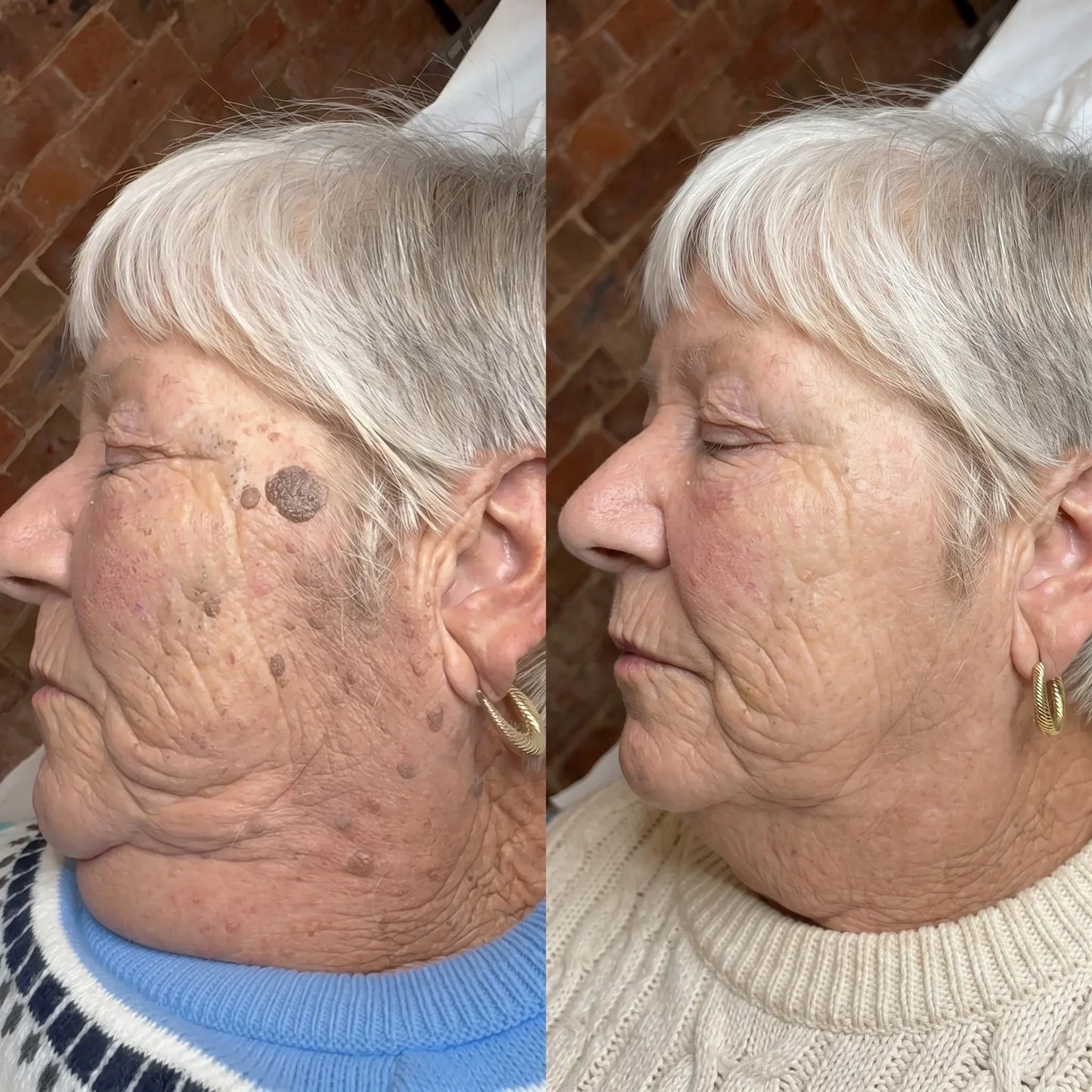 2026 SKIN RESTORATION ROUTINE-7-Day Skin Tag & Blemish Repair Pen