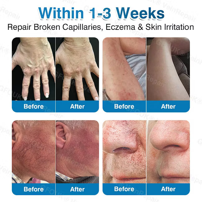 👨‍⚕️✅ VeinRepair Microneedle Patch Roll⚡Instant Relief, Long-Term Results
