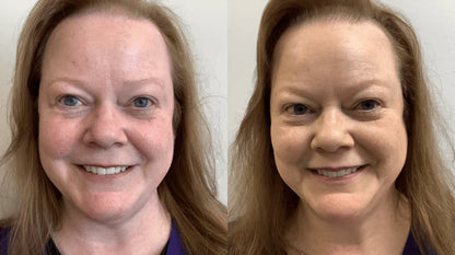 Rosacea Corrector