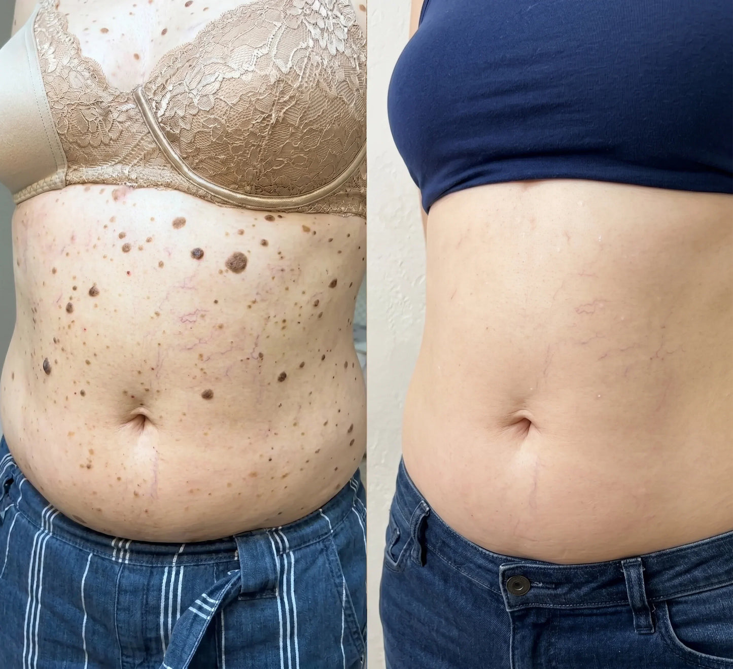 2026 SKIN RESTORATION ROUTINE-7-Day Skin Tag & Blemish Repair Pen