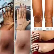 #1 Dermatologist-Recommended Cream for Dark Spots in Sensitive Areas