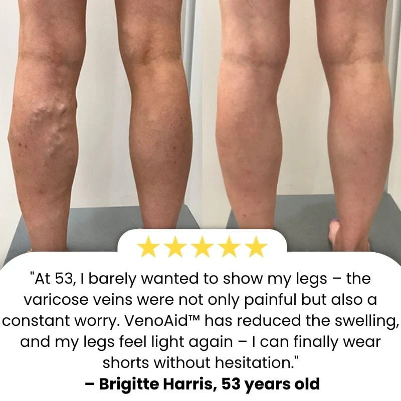 BARUBT Varicose Vein Solution Spray | Reduce Leg Pain and Swelling by 90% – Eliminate Varicose Veins in 2 Weeks!