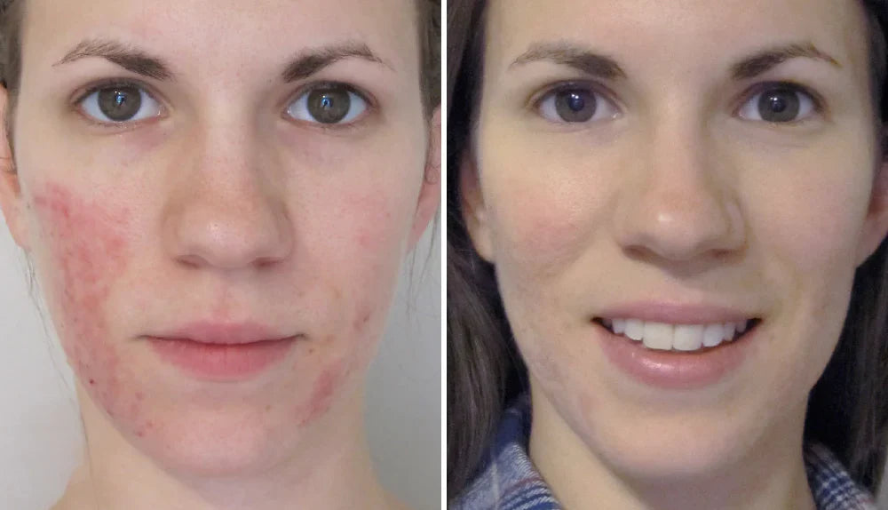 Rosacea Corrector