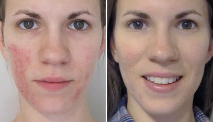 Rosacea Corrector